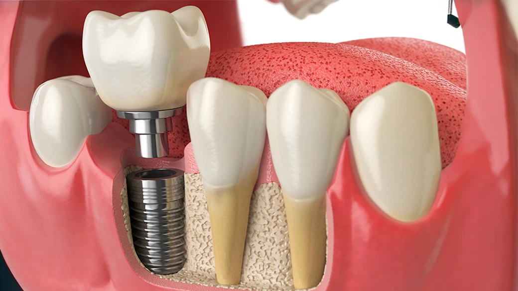 Implantes dentários Instituto Z